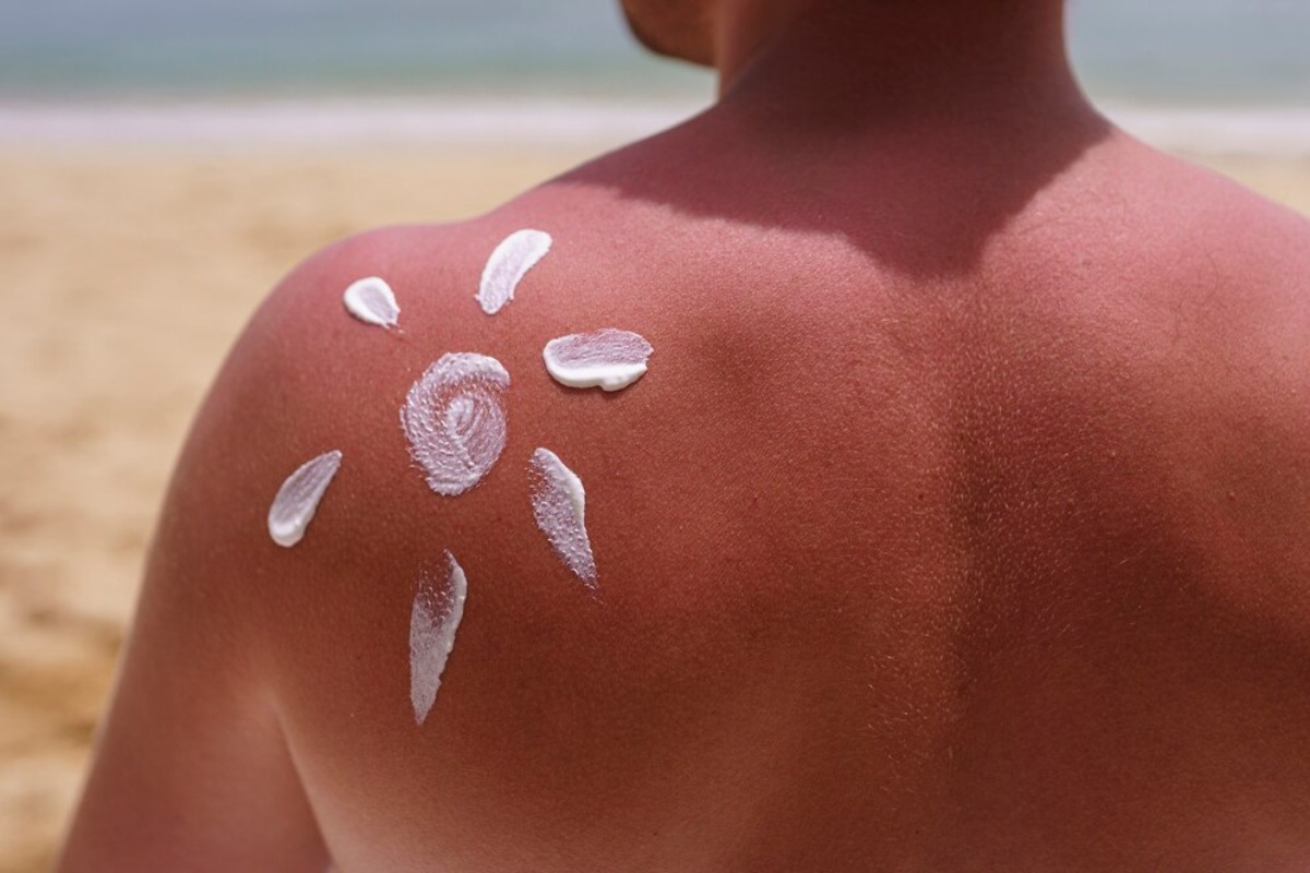 A sunburned back with white sunscreen applied in a sun shape, against a sandy beach background and calm ocean waters.
